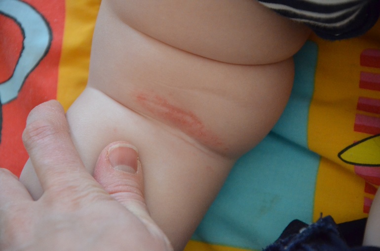 Это аллергия?