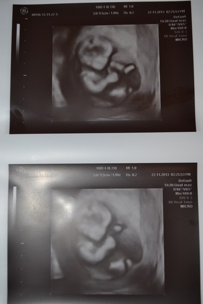 Наш первый скрининг...