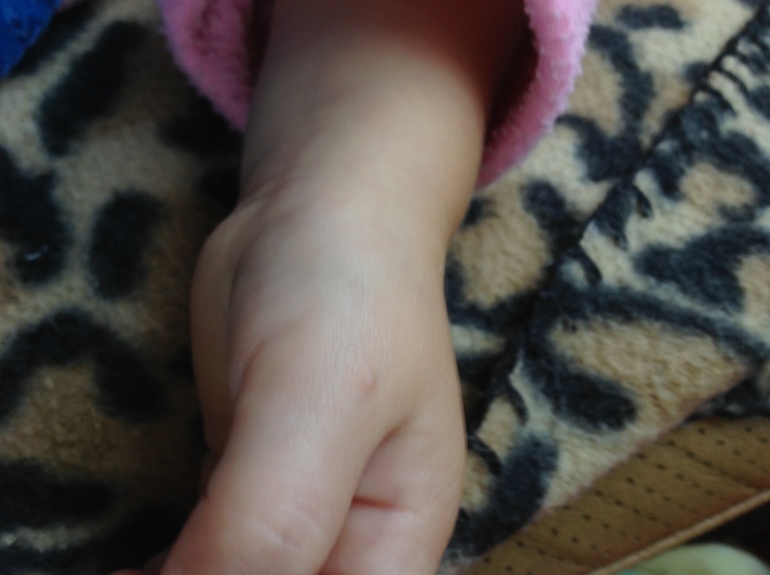 Бородавка. Откуда?