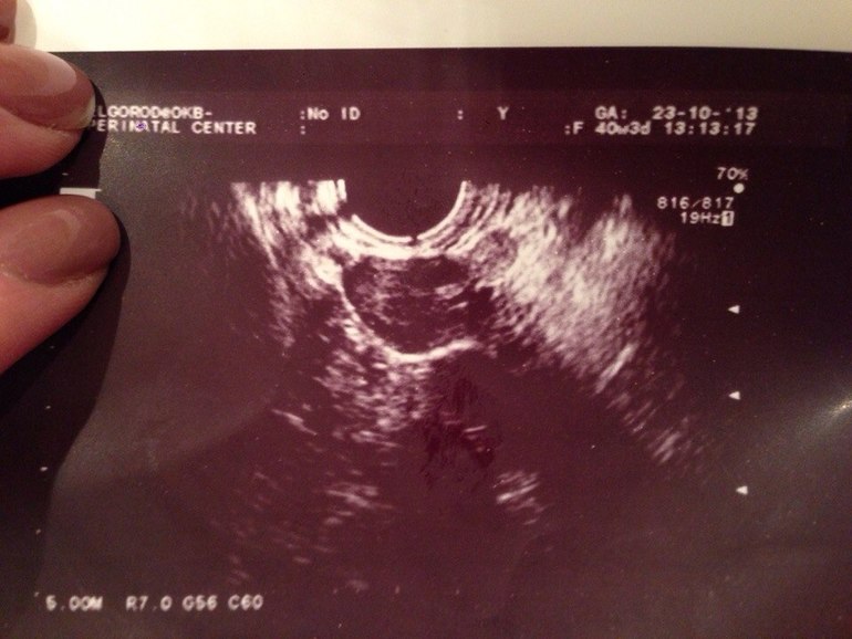 ПРОГНОЗ ВРАЧА ВБ!Я В УЖАСЕ ПРОСТО!!!ДЕВОЧКИ,ПОДДЕРЖИТЕ ПОЖАЛУЙСТА!!!