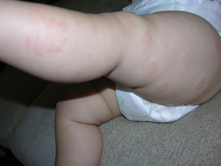 Красные шершавые пятна на ногах!