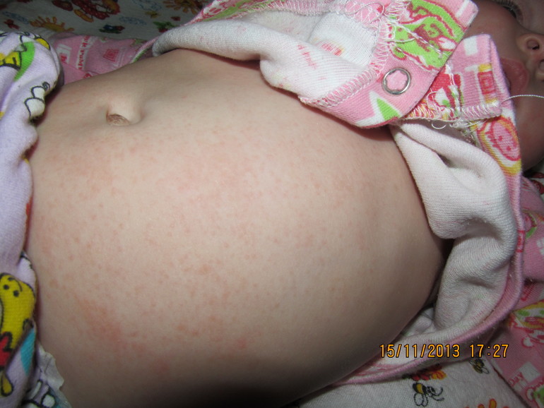 аллергия?????????????