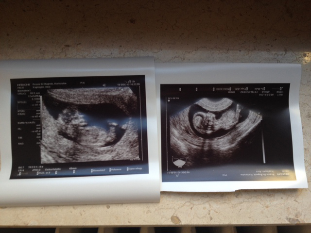 УЗИ - мальчик? девочка?