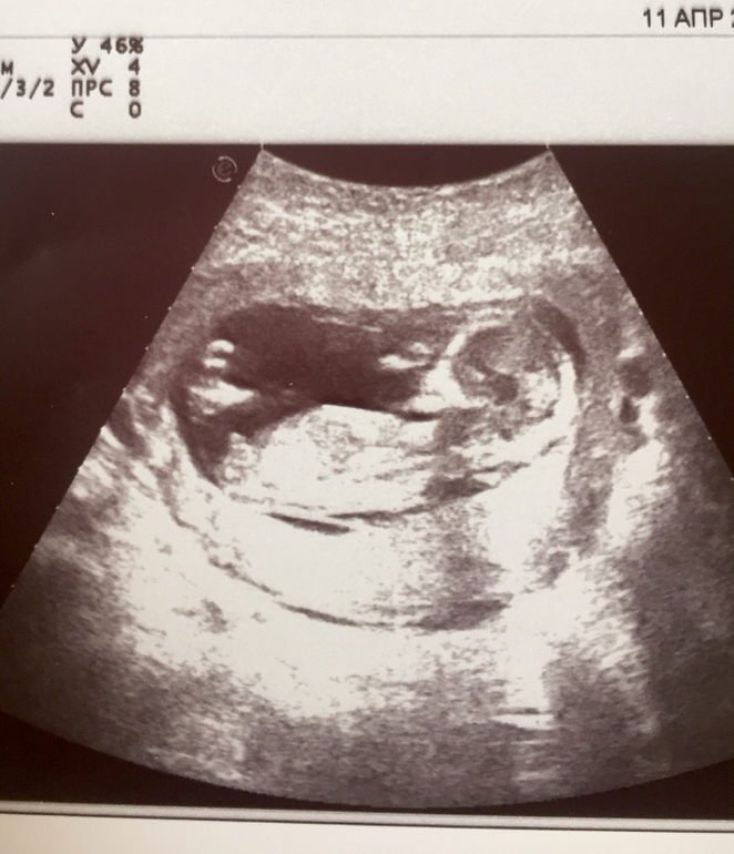 Фото ребенка 13 недель. УЗИ 13 недель беременности. 13 Недель 6 дней беременности.