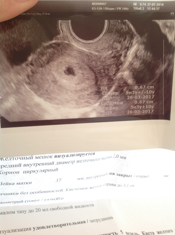 Неделя от зачатия форум. УЗИ три недели от зачатия. УЗИ 3-4 недели беременности. Эмбрион 4 недели от зачатия УЗИ.