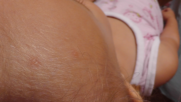 Это ветрянка или что........ ?