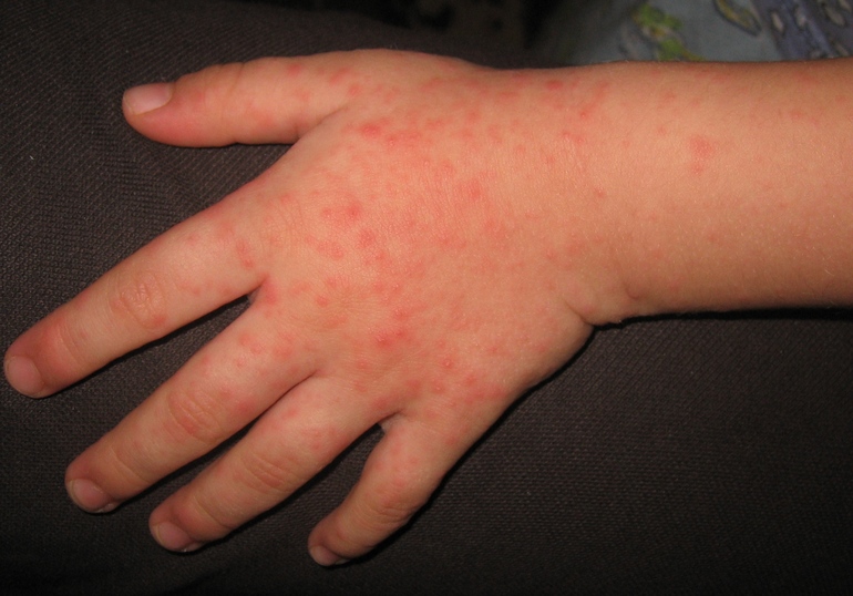 вчерашняя сыпь