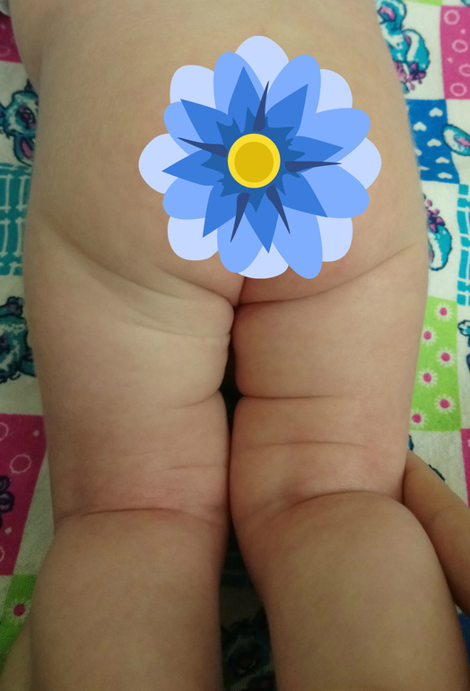 Несимметричные складки на ножках младенца: норма или повод бежать к врачу?