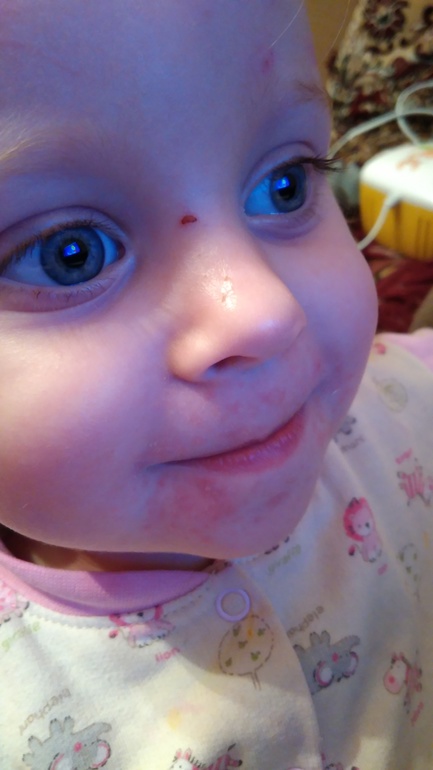 Сыпь в области носогубного треугольника у ребенка thumbnail