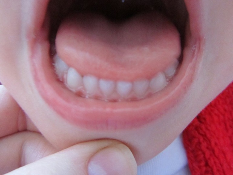 Как вылечить зубки?