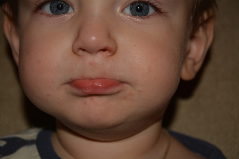 Диагноз: везикулярный стоматит с экзантемой. Синдром нога-рука-рот.