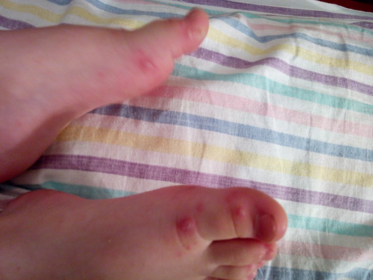 Что за волдыри такие?