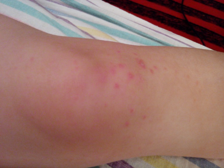 Что за волдыри такие?