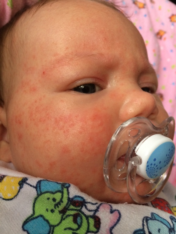 Аллергия на солнце у новорожденного фото