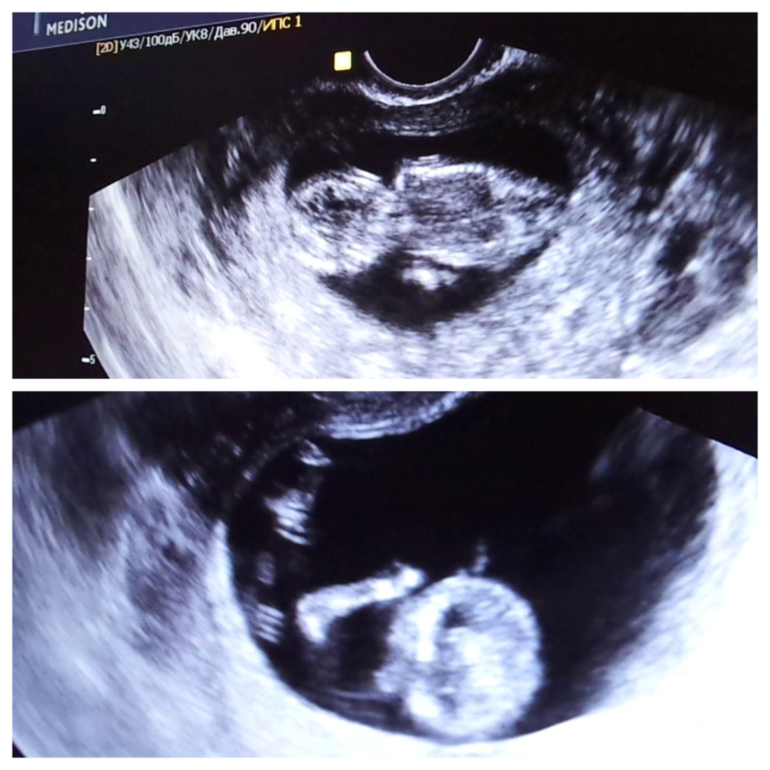 15 неделька, ремонт и наша попа:)