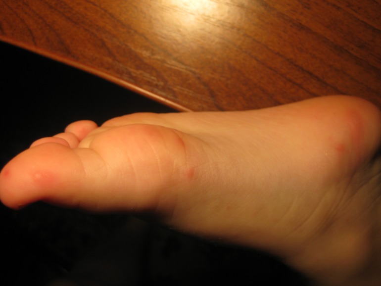 Это ветрянка?!