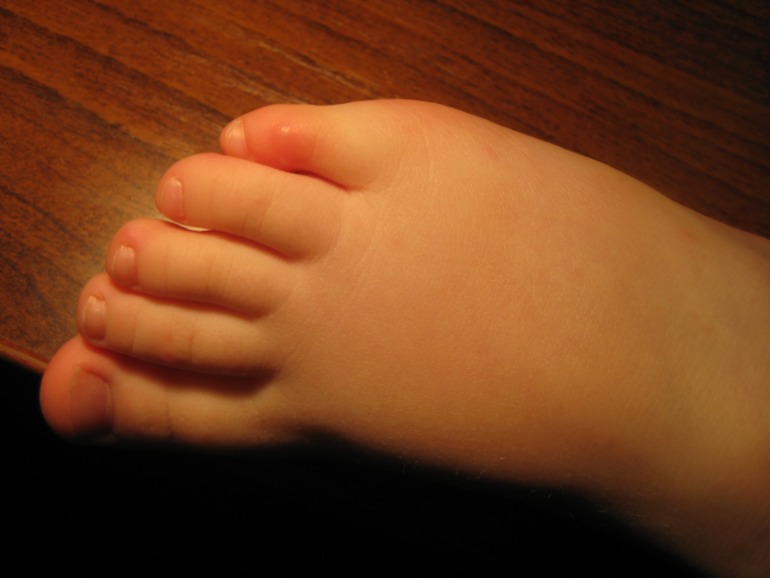 Это ветрянка?!