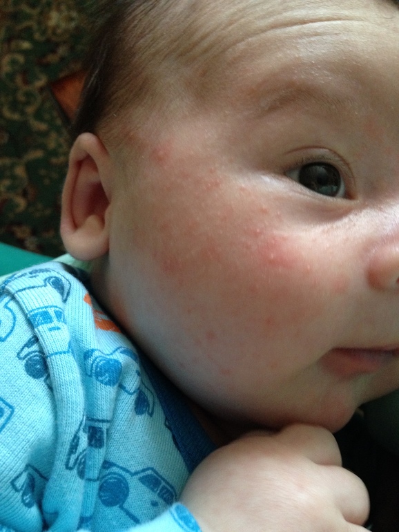 Опять про сыпь