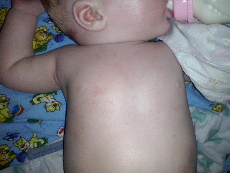 сыпь не понятная