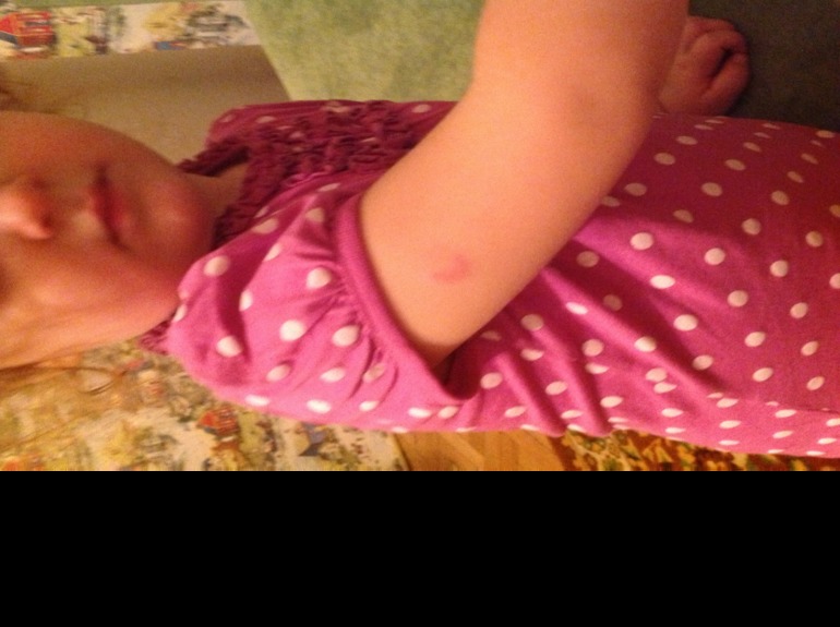 Кожная реакция на Гепатиты А и Б!!!