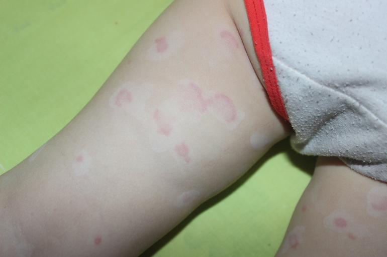 Опять пятна по телу!!!