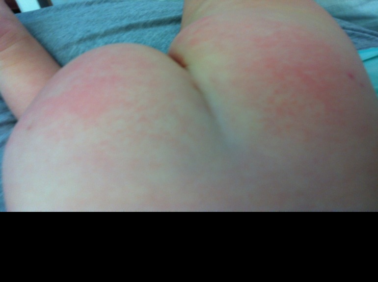 Розеола? С фото