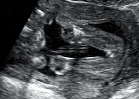 Стоп-кадры УЗИ (из видеоматериала)