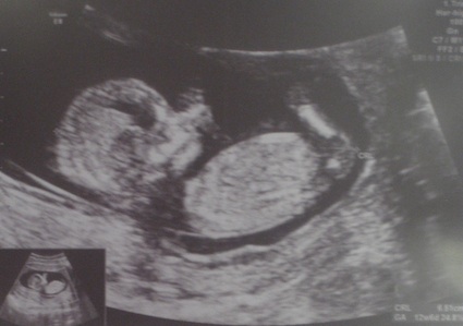 Этап "УЗИ-скриннинг" пройден!!