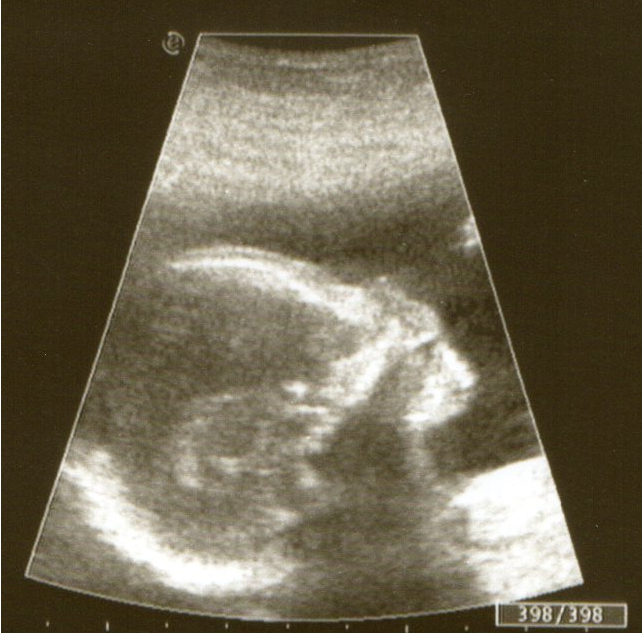 наш второй скрининг