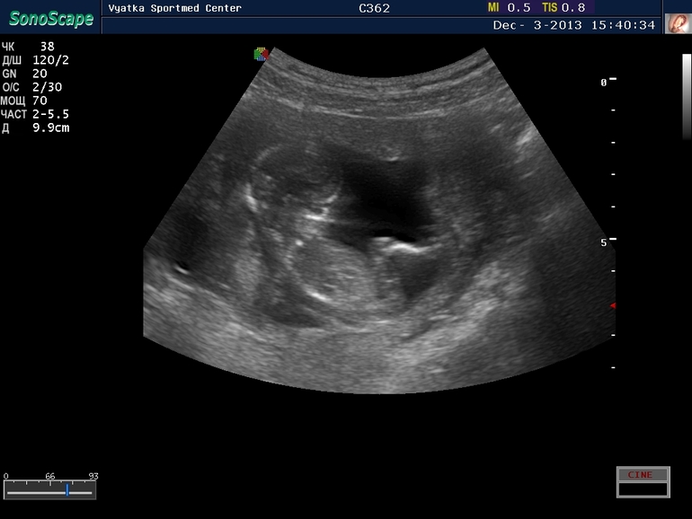 Первый скрининг