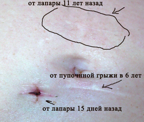 Большой живот после лапароскопии мимэктомии