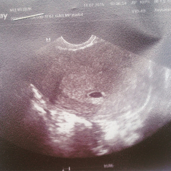 Как выглядит эмбрион в 5 недель беременности фото узи