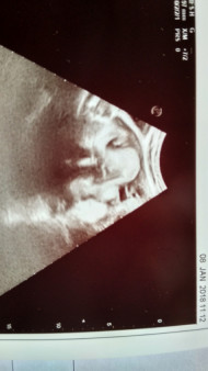 Фото УЗИ на 39 неделе беременности