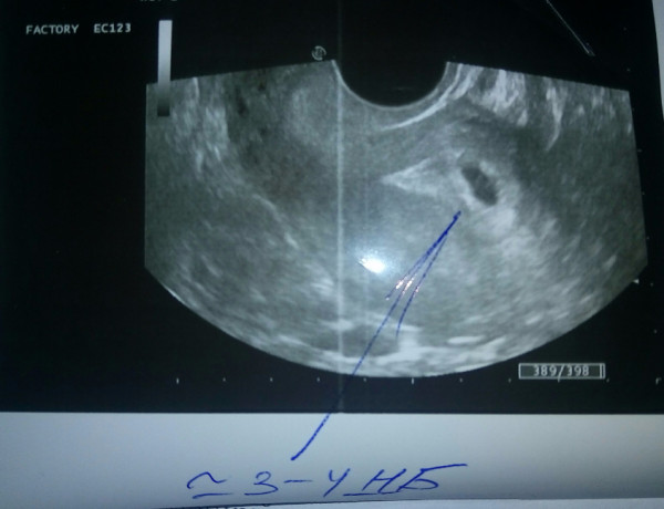 Как выглядит узи на 6 неделе. 6 Акушерских недель беременности на УЗИ. 6 Эмбриональных недель УЗИ. Как выглядит эмбрион в 6 недель на УЗИ.