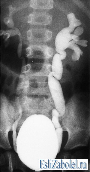 Пузырно мочеточниковый рефлюкс презентация
