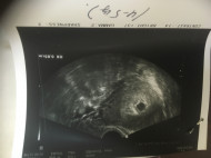 Фото УЗИ на 6 неделе беременности