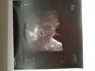 Фото УЗИ на 6 неделе беременности