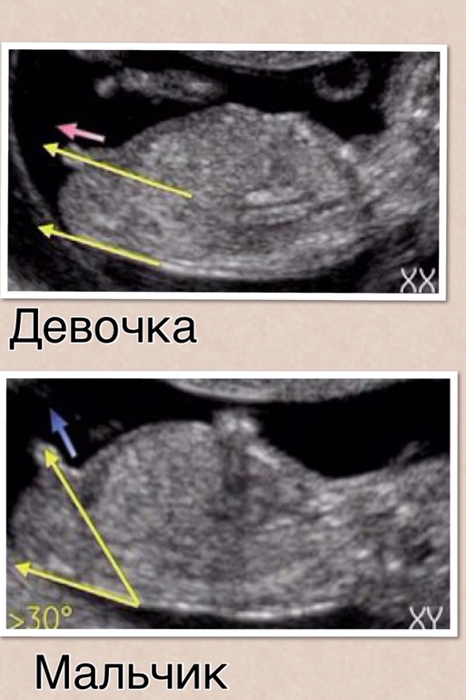Половой бугорок)
