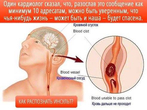 Инсульт