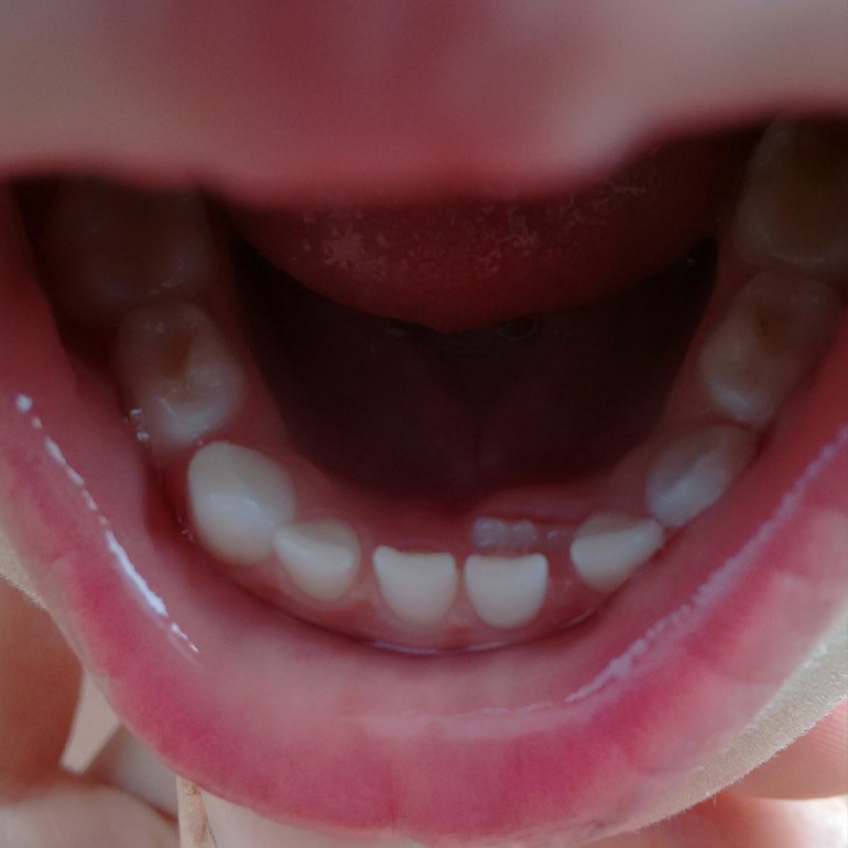 Молочный зуб фото