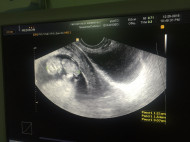 Фото УЗИ на 11 неделе беременности