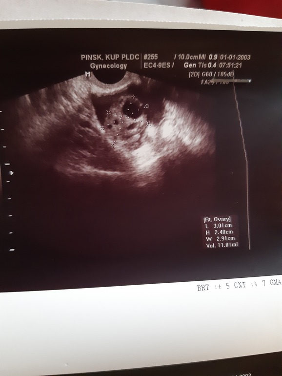 жидкость в левом яичнике — 25 рекомендаций на Babyblog.ru