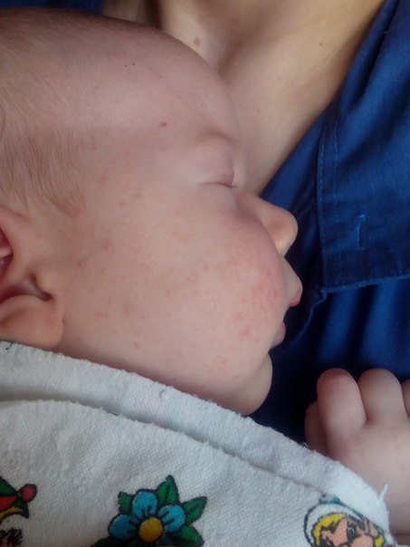 как быстро дейстует фенистил? Дубль 2 ))