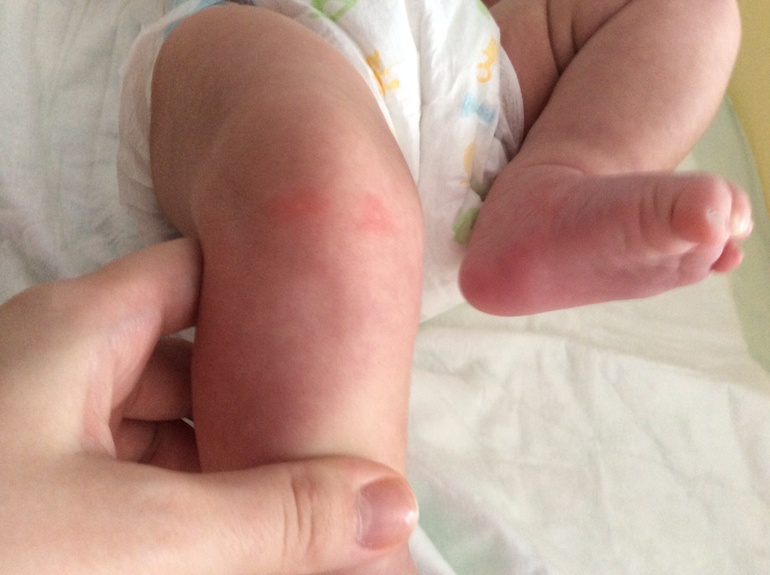 Пятна на ножках