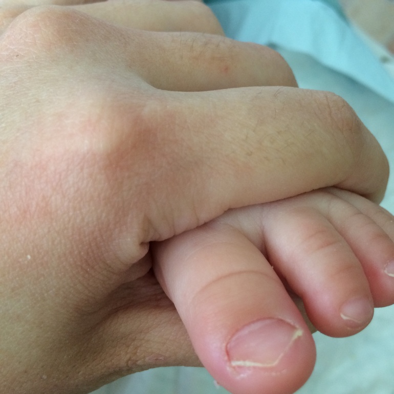 Может быть грибок ног?