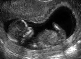 Наш первый скрининг: 11,3 недель (акушерский срок)