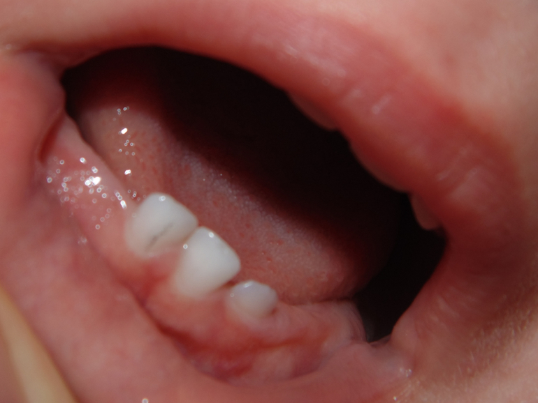 Темная полоска на зубике.