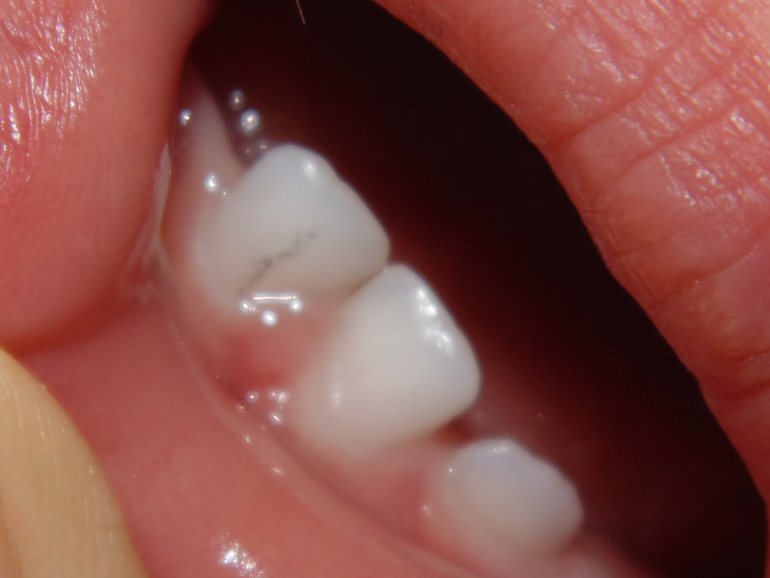 Темная полоса на зубике.