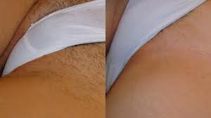 Элос эпиляция в Днепропетровске