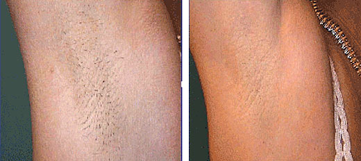 Элос эпиляция в Днепропетровске